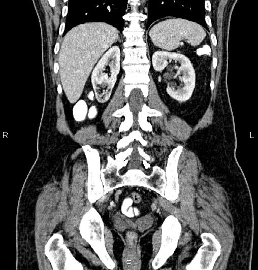 Cecal adenocarcinoma (Radiopaedia 85324-100916 D 48).jpg