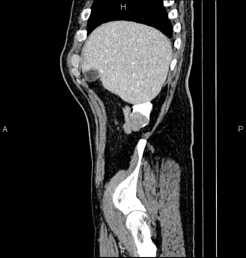 Cecal adenocarcinoma (Radiopaedia 85324-100916 E 13).jpg