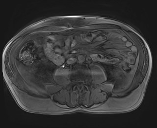 Cecal mass causing appendicitis (Radiopaedia 59207-66532 K 78).jpg