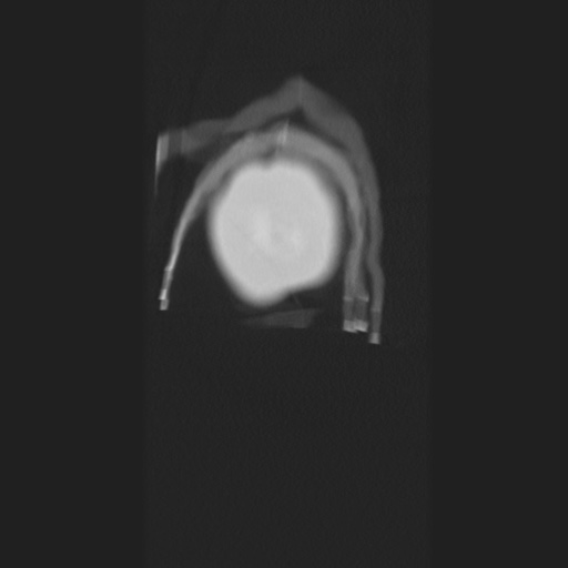 Cecal volvulus (Radiopaedia 75378-86620 Coronal lung window 6).jpg