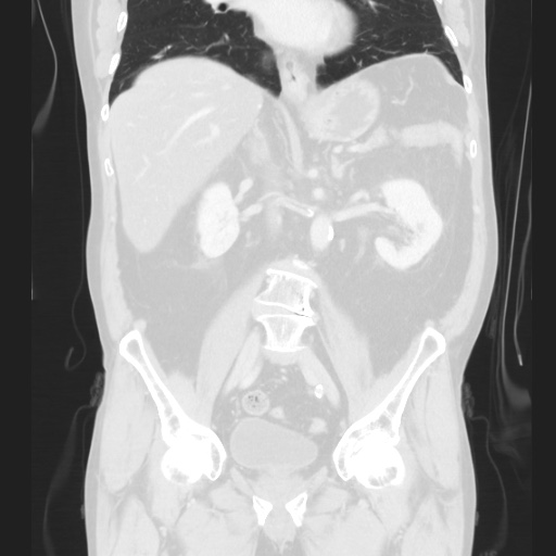 Cecal volvulus (Radiopaedia 75378-86620 Coronal lung window 81).jpg