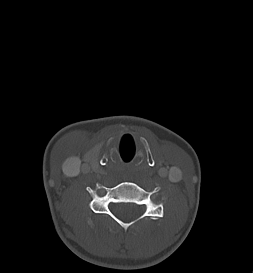 Cemento-ossifying fibroma (Radiopaedia 46243-50643 Axial bone window 57).png