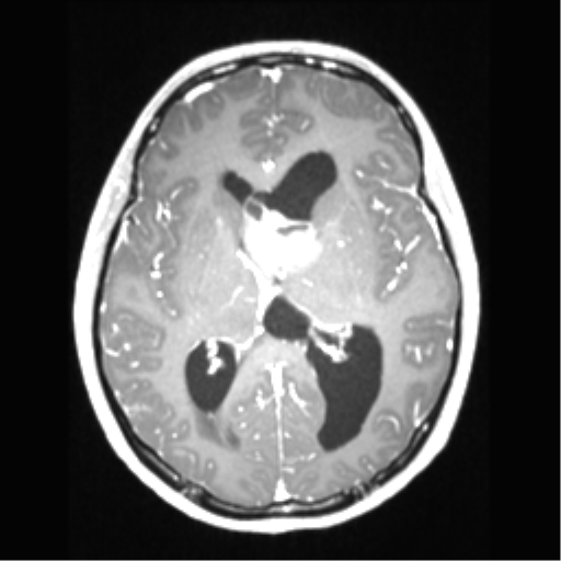 File:Central neurocytoma (Radiopaedia 37664-39557 Axial T1 C+ 42).png