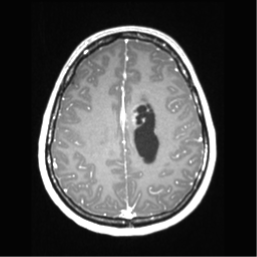 File:Central neurocytoma (Radiopaedia 37664-39557 Axial T1 C+ 57).png