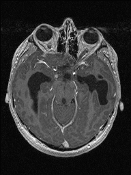 Central neurocytoma (Radiopaedia 56690-63469 Axial T1 C+ 59).jpg