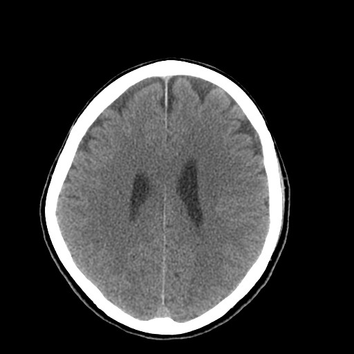 Central neurocytoma (Radiopaedia 68725-78432 Axial non-contrast 34).jpg