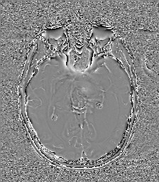 File:Central neurocytoma (Radiopaedia 84497-99872 Axial 31).jpg