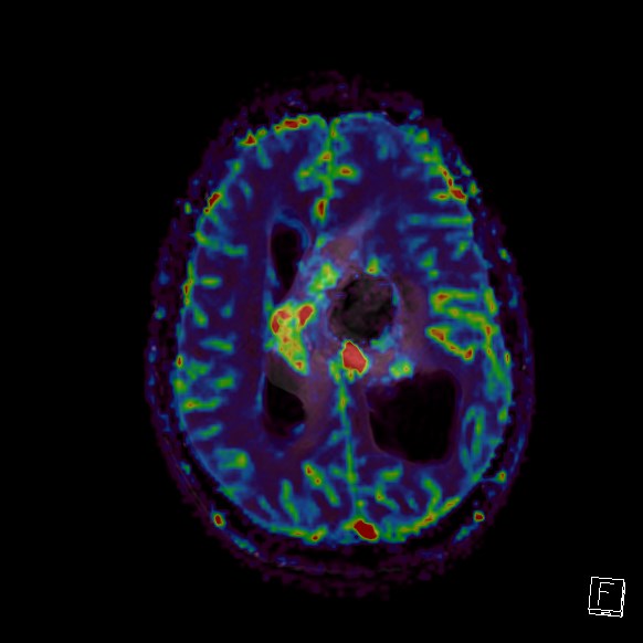 Central neurocytoma (Radiopaedia 84497-99872 Axial Perfusion 121).jpg