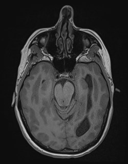 Central neurocytoma (Radiopaedia 84497-99872 Axial T1 74).jpg