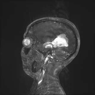 Central neurocytoma (Radiopaedia 84497-99872 Sagittal CISS 3).jpg