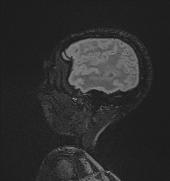 File:Central neurocytoma (Radiopaedia 84497-99872 Sagittal Flair + Gd 128).jpg