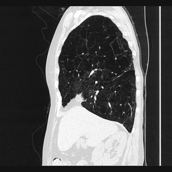 Centrilobular pulmonary emphysema (Radiopaedia 24495-24789 Sagittal lung window 27).jpg