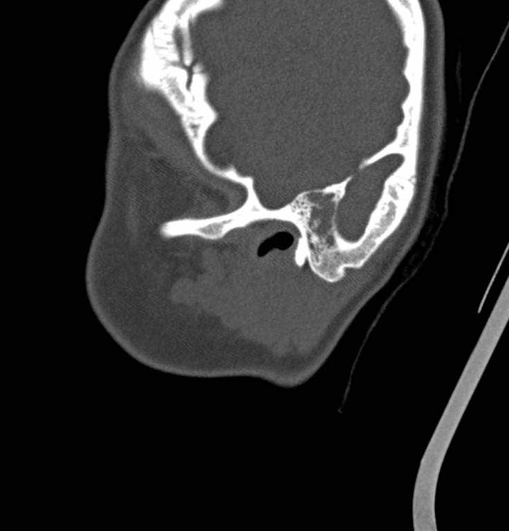 Cerebellar abscess (Radiopaedia 73727-84527 Sagittal bone window 37).jpg