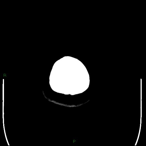 Cerebellar abscess (Radiopaedia 78135-90671 Axial non-contrast 114).jpg