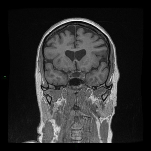 Cerebellar abscess (Radiopaedia 78135-90678 Coronal T1 C+ 61).jpg