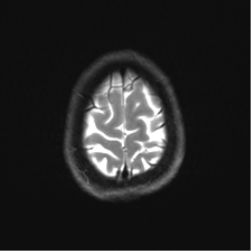 Cerebellar agenesis with hypoplastic pons (pontocerebellar hypoplasia) (Radiopaedia 57224-64138 Axial DWI 34).png