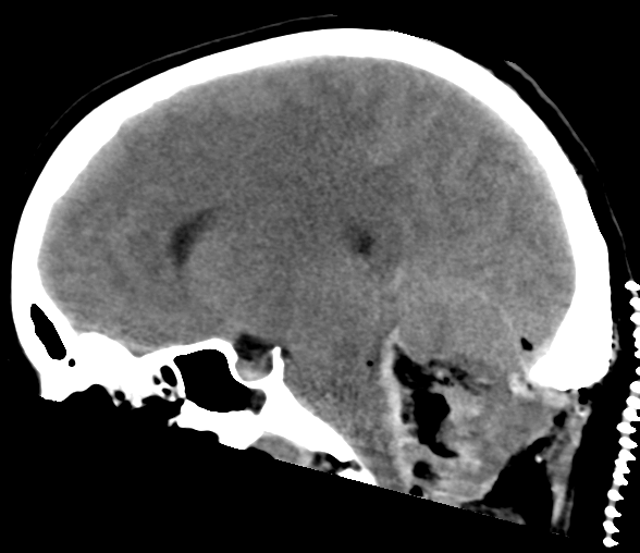 File:Cerebellar ependymoma complicated by post-operative subdural hematoma (Radiopaedia 83322-97737 C 15).png