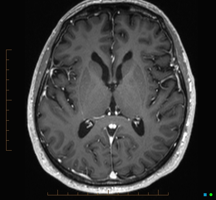 Cerebellar gangliocytoma (Radiopaedia 65377-74422 Axial T1 C+ 68).jpg