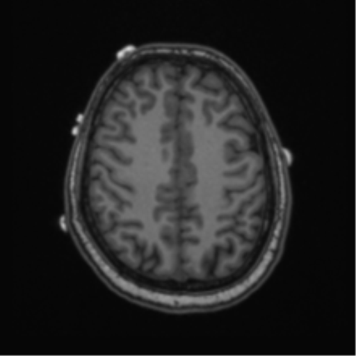 Cerebellar hemangioblastomas and pituitary adenoma (Radiopaedia 85490-101176 Axial T1 54).png