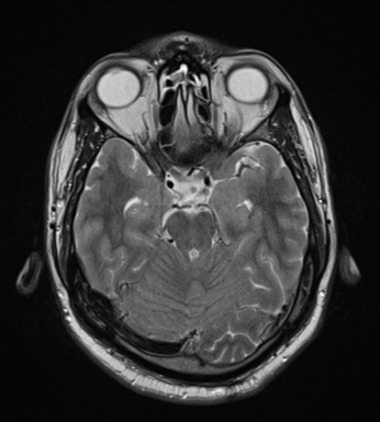 File:Cerebellar hemangioblastomas and pituitary adenoma (Radiopaedia 85490-101176 Axial T2 13).png