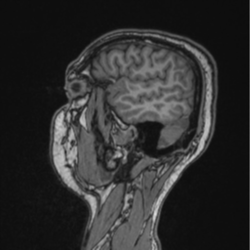 Cerebellar hemangioblastomas and pituitary adenoma (Radiopaedia 85490-101176 Sagittal T1 76).png