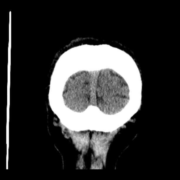 Cerebellar hemorrhage (Radiopaedia 27193-27359 Coronal non-contrast 54).jpg