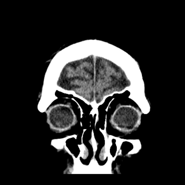Cerebellar hemorrhage (Radiopaedia 27193-27359 Coronal non-contrast 9).jpg