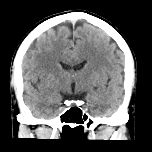 File:Cerebellar hemorrhage (Radiopaedia 37000-38669 Coronal non-contrast 22).png