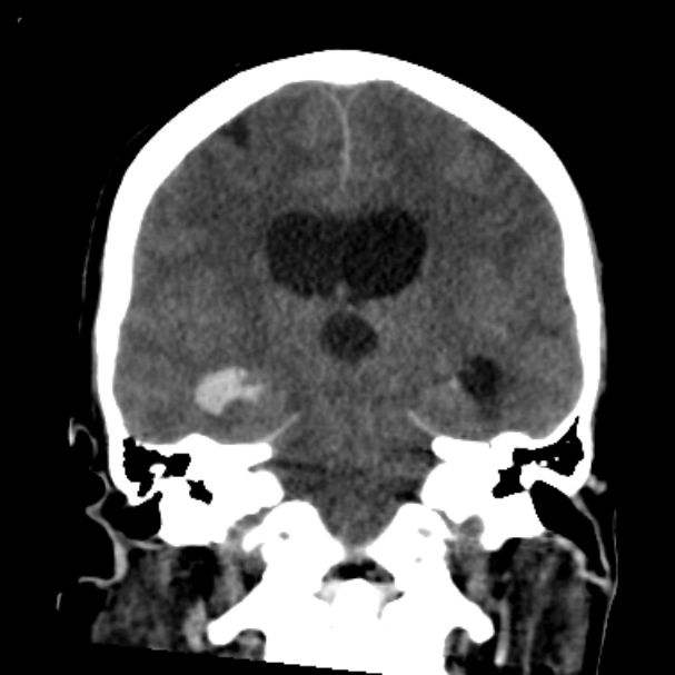Cerebellar hemorrhage causing obstructive hydrocephalus (Radiopaedia 33989-35207 Coronal non-contrast 31).jpg