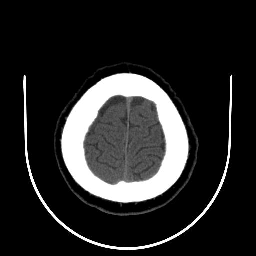 File:Cerebellar infarction (Radiopaedia 16625-16327 Axial non-contrast 34).jpg