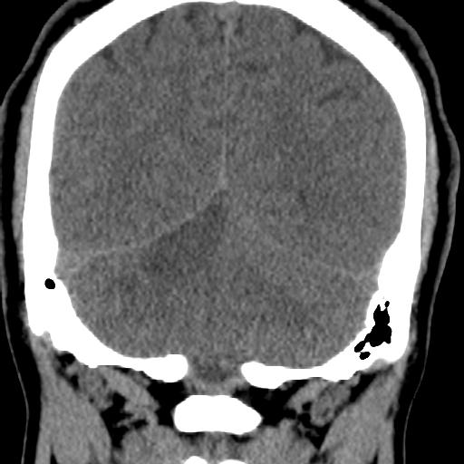 Cerebellar infarction (Radiopaedia 16625-16327 Coronal non-contrast 29).jpg
