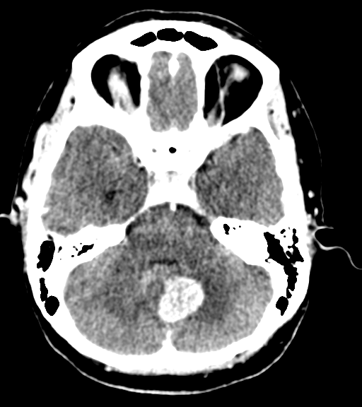 File:Cerebellar metastases - colorectal adenocarcinoma (Radiopaedia 40947-43652 Axial C+ 14).png