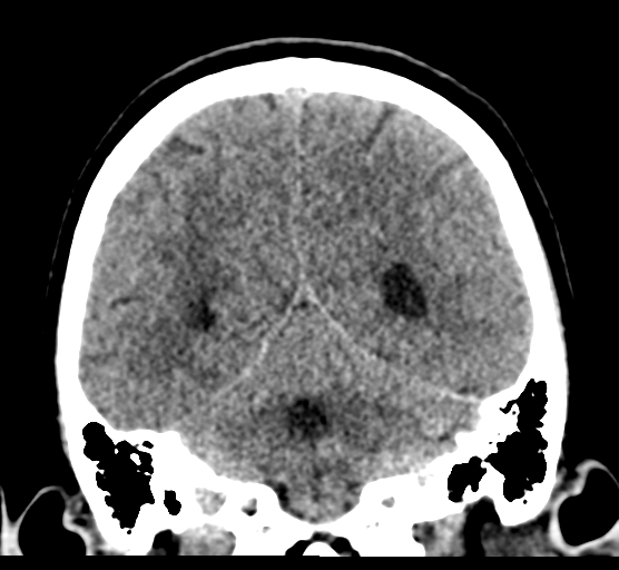 Cerebellar metastases - colorectal adenocarcinoma (Radiopaedia 40947-43652 Coronal non-contrast 66).png
