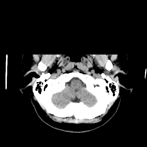 Cerebellar metastasis (cystic appearance) (Radiopaedia 41395-44258 Axial non-contrast 8).png