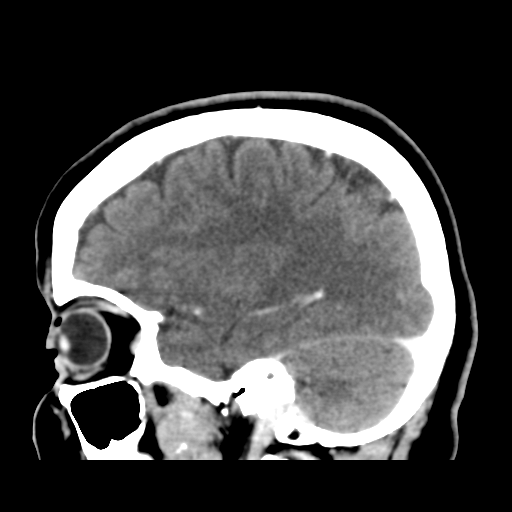 Cerebellar metastasis (cystic appearance) (Radiopaedia 41395-44258 F 17).png