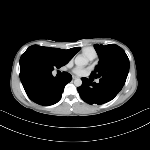 File:Cerebellar metastasis - adenocarcinoma lung (Radiopaedia 63184-71717 Axial C+ delayed 36).png