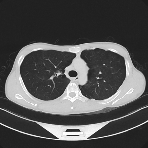 Cerebellar metastasis - adenocarcinoma lung (Radiopaedia 63184-71717 Axial lung window 24).png