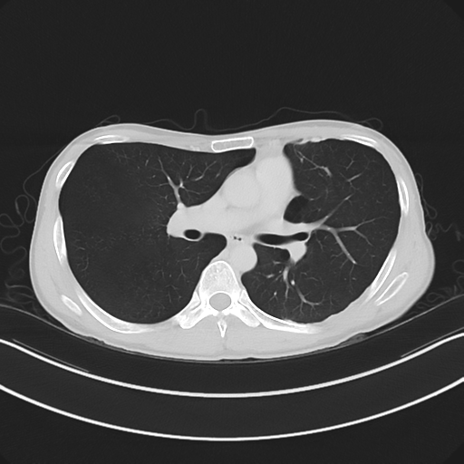 Cerebellar metastasis - adenocarcinoma lung (Radiopaedia 63184-71717 Axial lung window 33).png