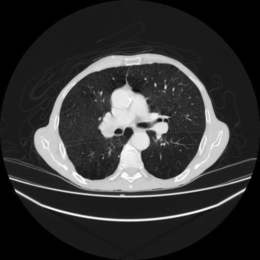 File:Cerebellar metastasis - lung tumor (Radiopaedia 69317-79150 Axial lung window 16).jpg