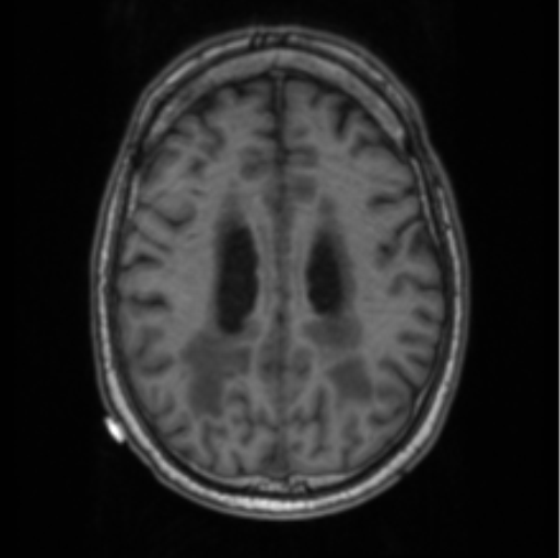 Cerebellar metastasis from lung adenocarcinoma (Radiopaedia 86690-102829 Axial T1 57).png