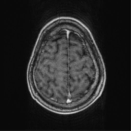 Cerebellar metastasis from lung adenocarcinoma (Radiopaedia 86690-102829 Axial T1 C+ 67).png