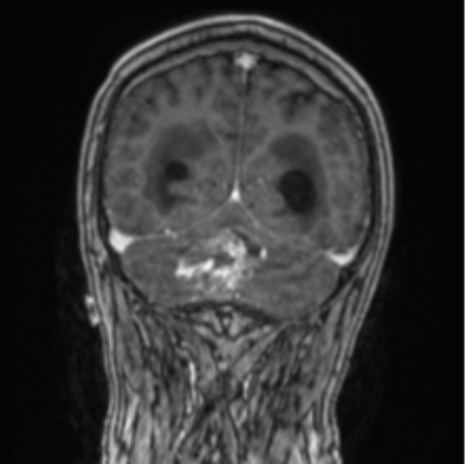 Cerebellar metastasis from lung adenocarcinoma (Radiopaedia 86690-102829 Coronal T1 C+ 27).png