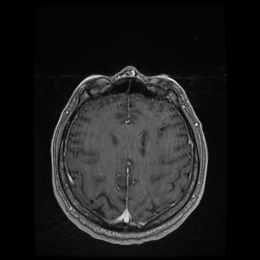 Cerebellar metastasis of pulmonary adenocarcinoma, cavernous venous malformation, and developmental venous anomaly (Radiopaedia 85827-101661 Axial T1 C+ 67).jpg