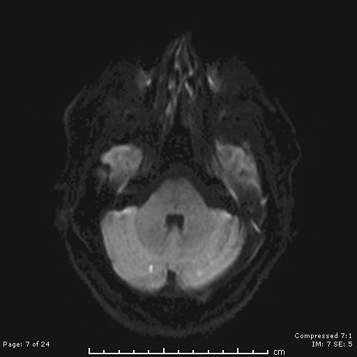 File:Cerebellar strokes due to intracranial giant cell arteritis (Radiopaedia 68799-81713 Axial DWI 7).jpg