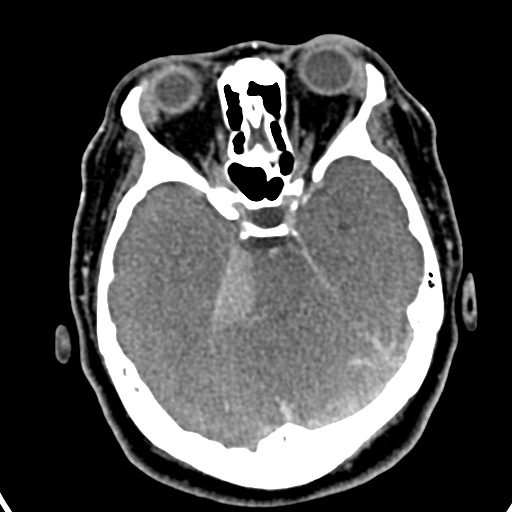 Cerebellopontine angle meningioma (Radiopaedia 35181-36714 A 11).jpg