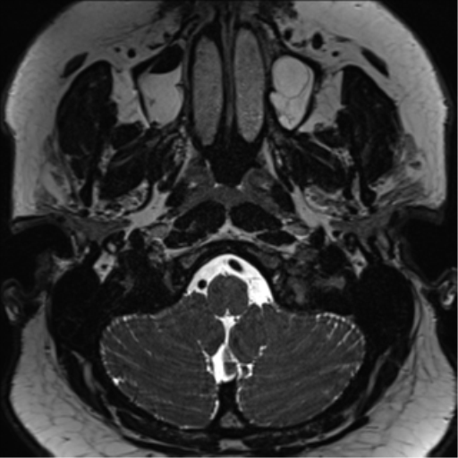 Cerebellopontine angle meningioma (Radiopaedia 48434-53348 Axial T2 Space 15).png