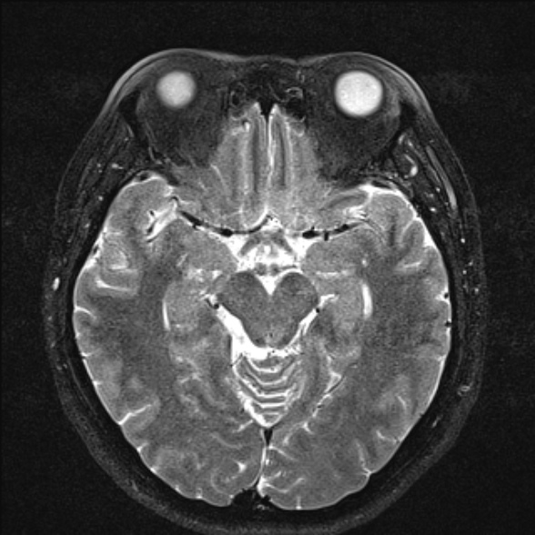 File:Cerebellopontine angle meningioma (Radiopaedia 53561-59591 Axial T2 fat sat 21).jpg