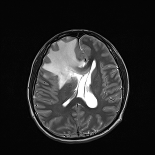 Cerebral abscess (Radiopaedia 24212-24478 Axial T2 37).jpg