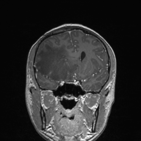 File:Cerebral abscess (Radiopaedia 24212-24478 Coronal T1 C+ 89).jpg