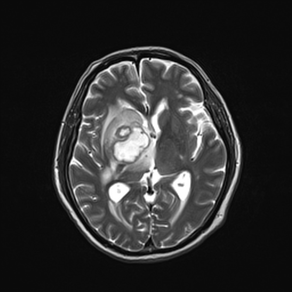 Cerebral abscess (Radiopaedia 26111-26247 Axial T2 33).jpg